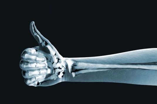 X-ray upang masuri ang sakit sa mga kasukasuan ng mga daliri