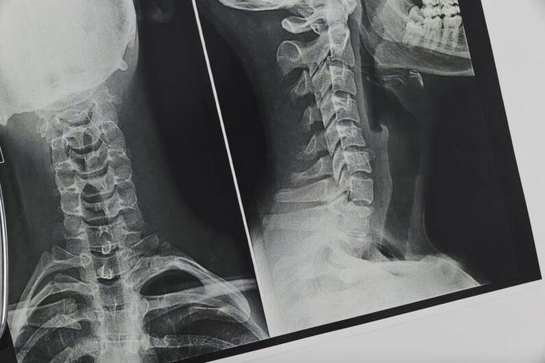 X-ray ng cervical spine na apektado ng osteochondrosis