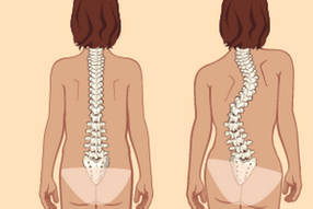 tuwid na postura at scoliosis na may thoracic osteochondrosis