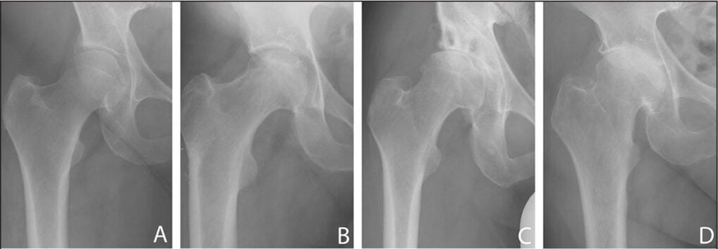 Mga yugto ng pag-unlad ng arthrosis ng hip joint sa isang x-ray