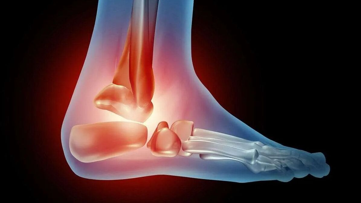 diagram ng ankle arthrosis