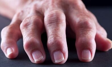 Ano ang pagkakaiba sa pagitan ng arthritis mula sa arthrosis