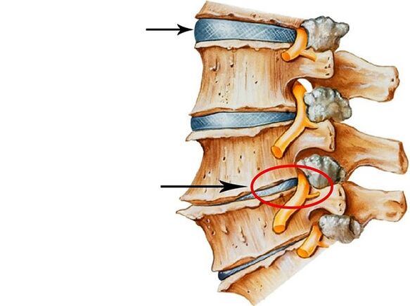 Mga karamdaman sa mga intervertebral disc