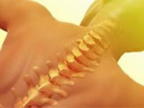 Osteochondrosis - Sakit sa gulugod