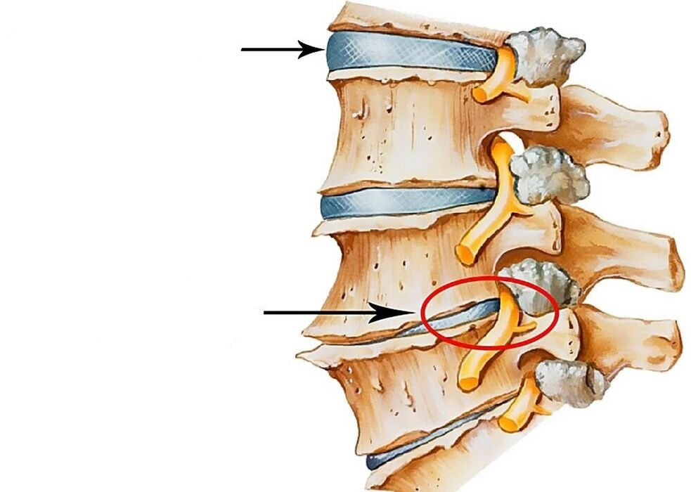 paglalarawan ng malusog at deformed spinal disc