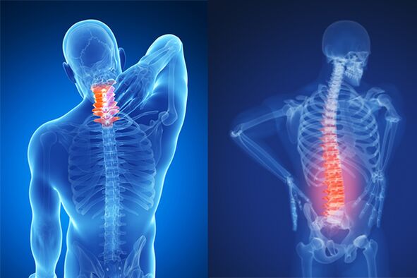 Osteochondrosis ng cervical at lumbar spine