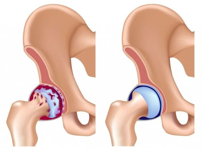 Pinsala sa hip joint dahil sa arthrosis