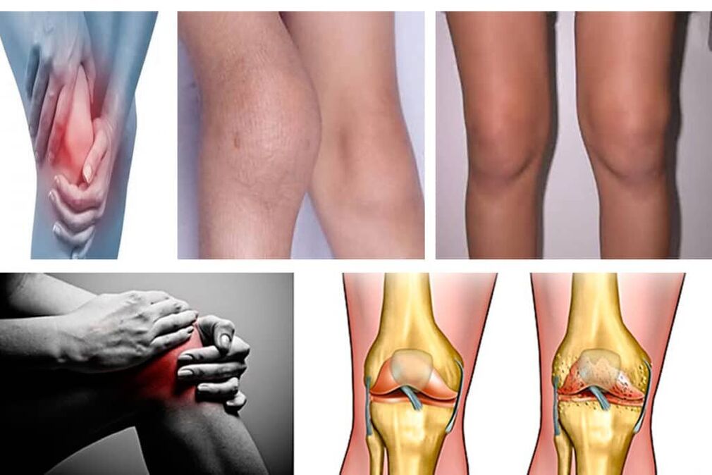 arthrosis ano ito