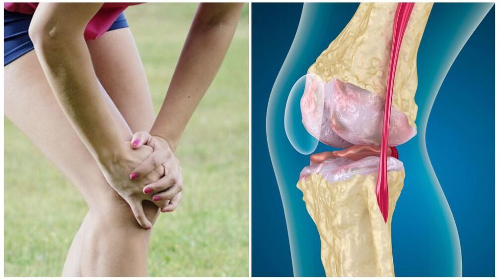 sintomas ng arthrosis