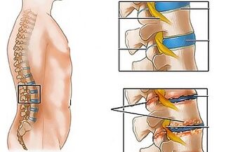 Ang mga sanhi ng osteochondrosis ng lumbar