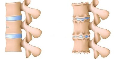 Paano makilala ang pagkakaroon ng osteochondrosis ng lumbar